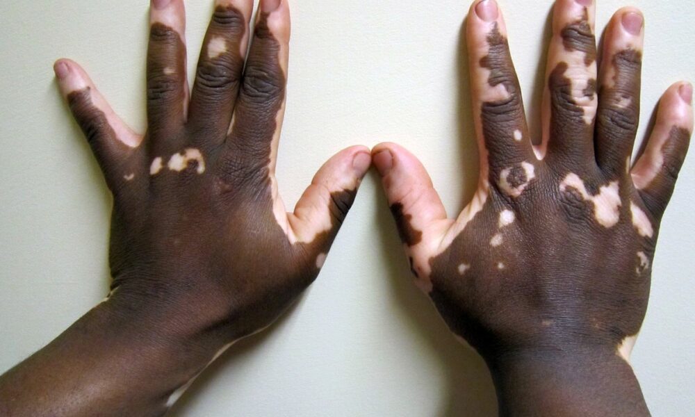 Vitiligo: Belirtileri, Nedenleri ve Tedavi Yöntemleri Vitiligo cilt renk kaybı beyaz lekeler