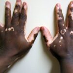 Vitiligo cilt renk kaybı beyaz lekeler