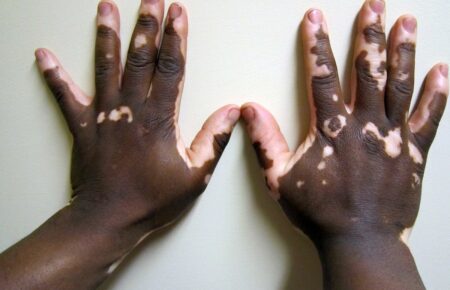 Vitiligo cilt renk kaybı beyaz lekeler