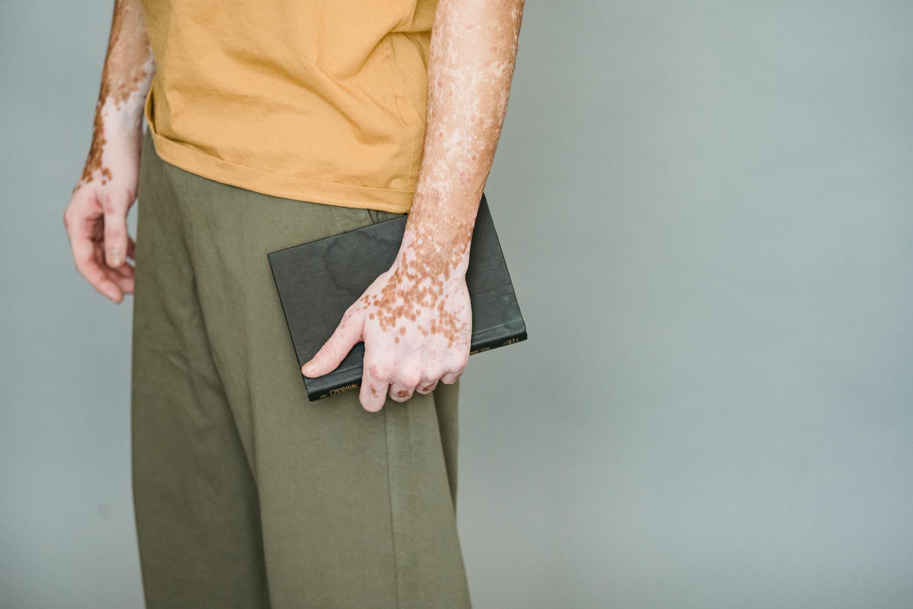 Vitiligo: Belirtileri, Nedenleri ve Tedavi Yöntemleri 2 Vitiligo: Belirtileri, Nedenleri ve Tedavi Yö - 4